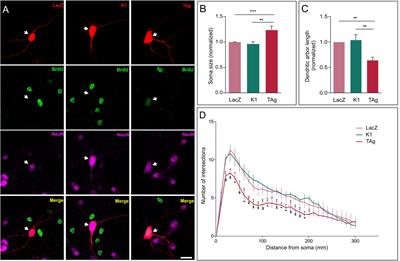 Pathological Aspects of Neuronal Hyperploidization in Alzheimer’s Disease Evidenced by Computer Simulation